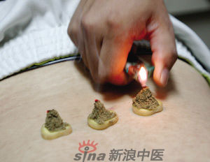 灸法的種類  你知道多少？